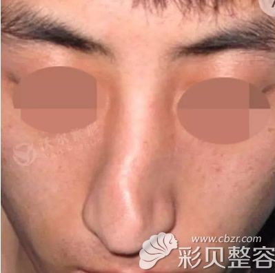 我的肋软骨隆鼻变形怎么办 看北京沃尔刘彦军修复效果如何