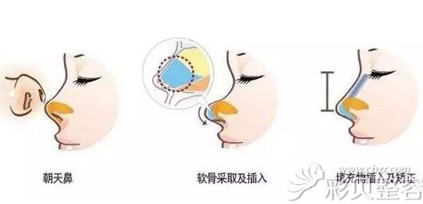 鼻头软骨取出会凹陷吗