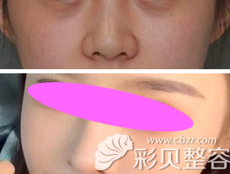 刘强医生做的膨体+耳软骨隆鼻3个月效果图