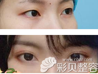 刘强医生做的全切7mm双眼皮一个月效果对比照
