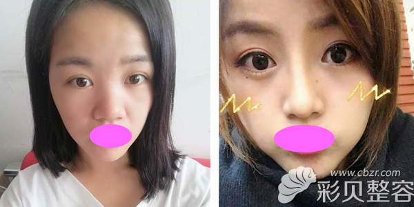南京施尔美整形刘卫韩式小翘鼻术后一个月对比效果
