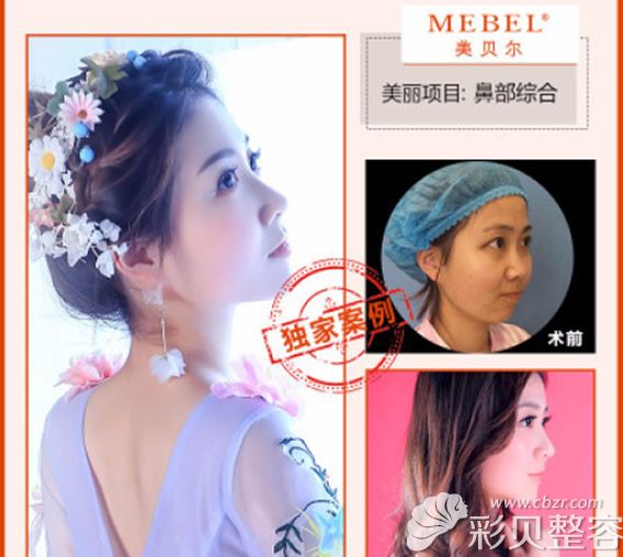 南京美贝尔黄名斗鼻综合手术前后对比照片