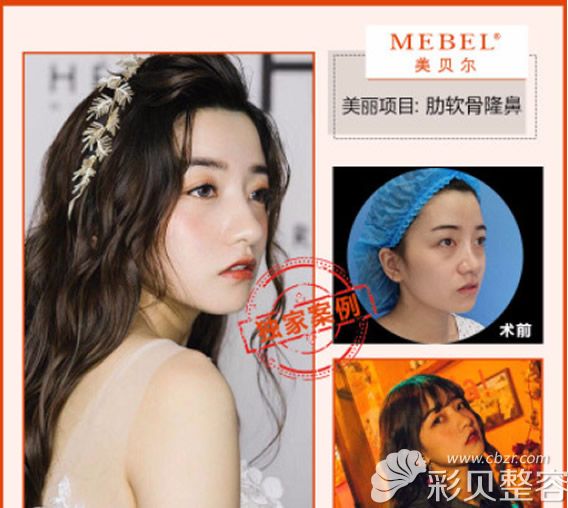 黄名斗自体肋软骨隆鼻案例