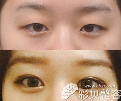 韩国新帝瑞娜双眼皮手术术前术后对比图