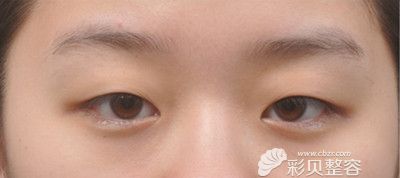 韩国新帝瑞娜双眼皮手术术前照
