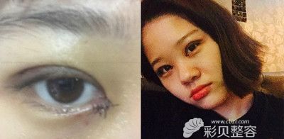 韩国新帝瑞娜双眼皮手术术后五天