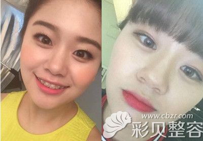 韩国新帝瑞娜双眼皮手术术后两个月