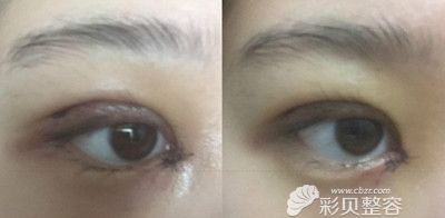 韩国新帝瑞娜双眼皮手术术后两天