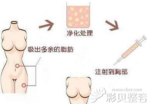 广州名韩整形自体脂肪隆胸脂肪提取部位
