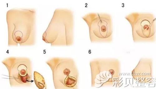 双环法乳房下垂矫正术过程