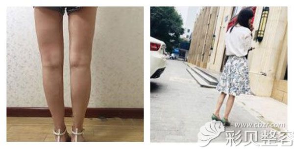 王贺做大小腿吸脂真人案例效果对比图