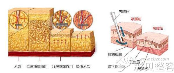 大腿抽脂2500CC多不多呢