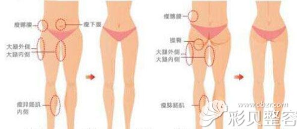 大腿吸脂真的有效果吗