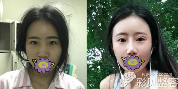 来看成都成美整形冯春雨鼻部失败修复案例还你健康美鼻