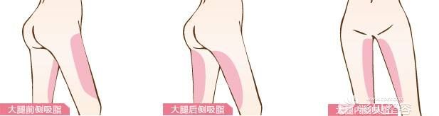 大腿吸脂术部位展示