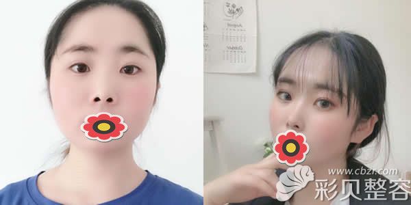广州画美整形陈坦医生注射玻尿酸瘦脸前后效果对比