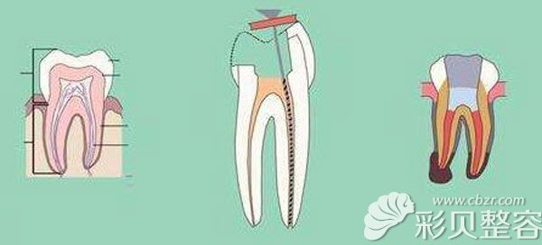 根管治疗和拔牙哪个好？