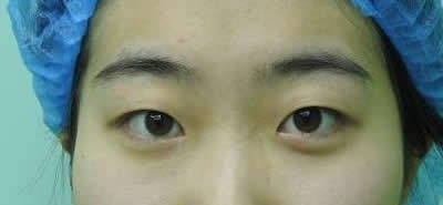 实名夸赞广州高尚整形余文林院长,朋友说我割的双眼皮好看
