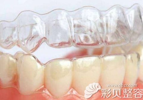隐形牙齿矫正可以改善牙套脸