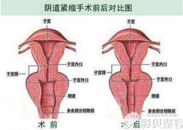 韩国好手艺整形阴道紧缩手术前后对比图