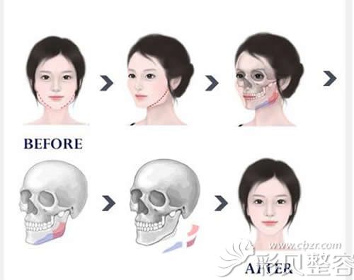 韩国faceline(菲斯莱茵)整形外科面部轮廓优势介绍