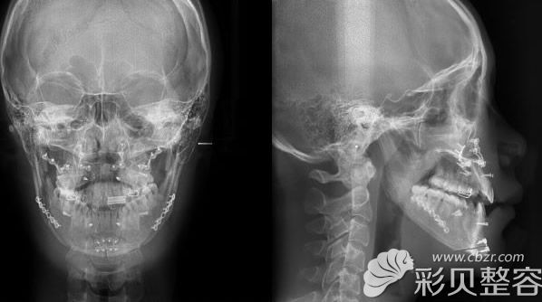 双鄂手术前拍的X光片 双鄂手术前拍的X光片