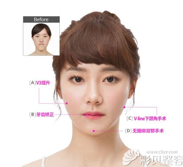 韩国id整形外科面部轮廓综合整形一年后效果 韩国id整形外科面部轮廓综合整形一年后效果