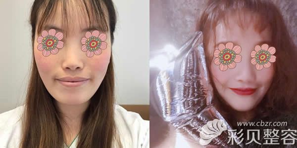 韩国id整形外科朴相熏院长上下颚突出矫正真人案例效果