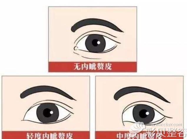 内眦赘皮又称"蒙古皱襞",主要表现为内眦部纵向的皮肤皱褶将正常的