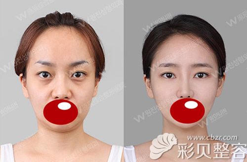 韩国原辰整形外科朴院长硅胶+耳软骨隆鼻前后对比照片