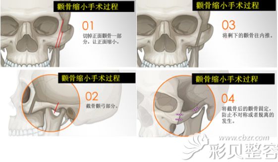 颧骨内推手术过程及颧骨整形后钛钉固定的位置