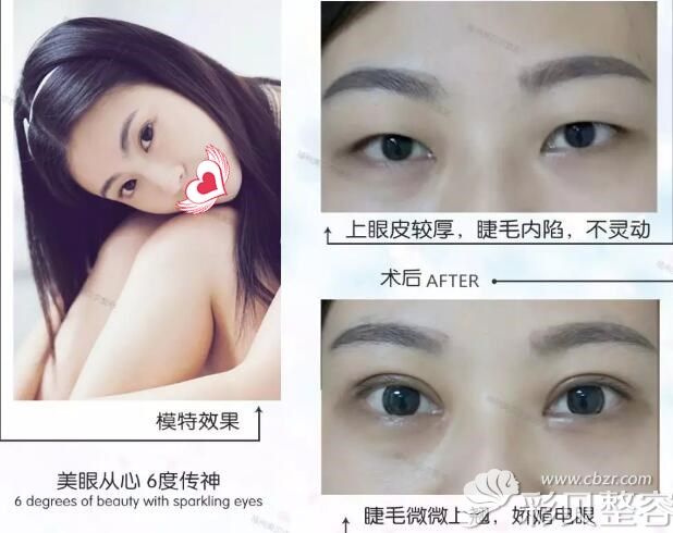 杨国化全切双眼皮+去脂手术案例效果对比图