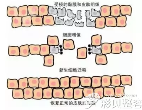 彩光嫩肤治疗的原理修复受损的皮肤屏障