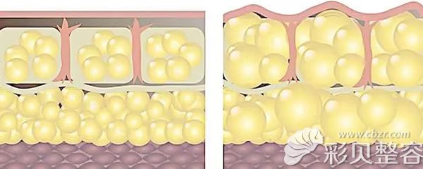 面部吸脂脂肪数量减少示意图