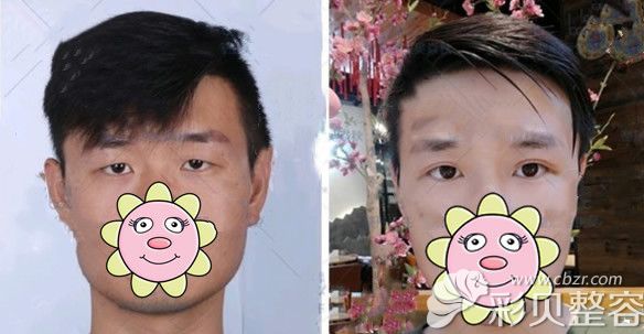 男生三角眼割双眼皮效果图