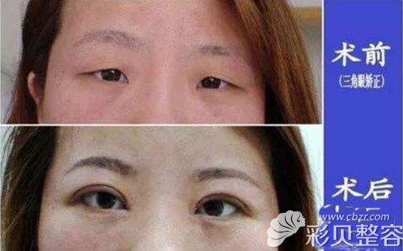 女生三角眼割双眼皮效果怎么样
