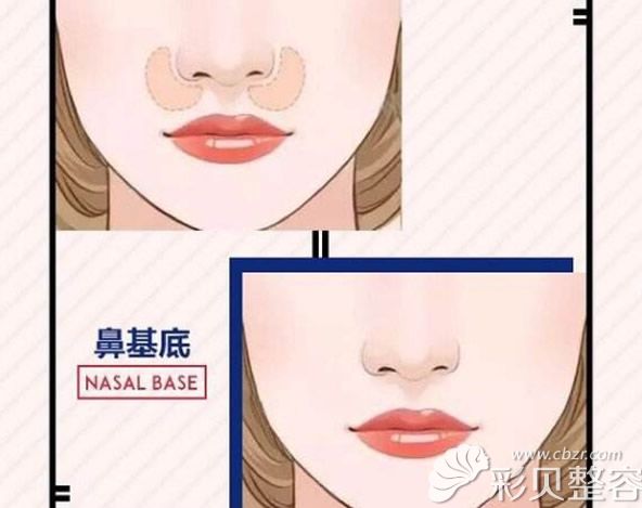 自体脂肪垫鼻基底效果好吗为什么有些人鼻基底填充变丑了