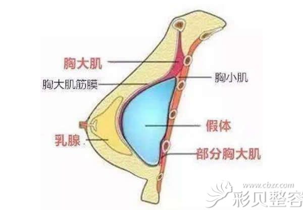 假体隆胸假体植入位置示意图