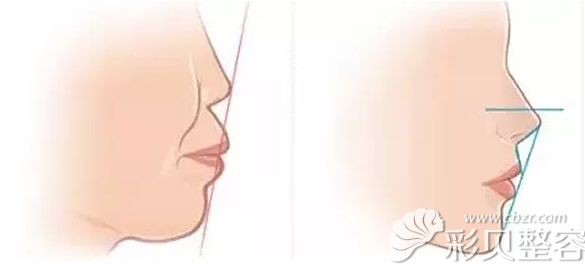 综合鼻整形能解决突嘴
