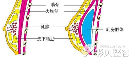 隆胸假体放置的位置