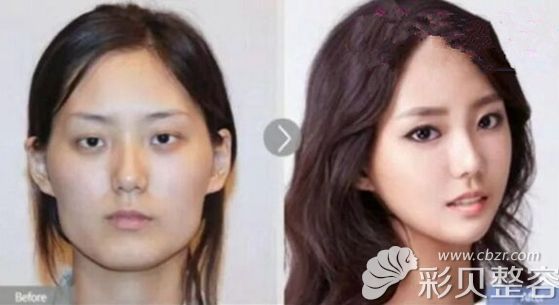 韩国面部轮廓手术前后对比