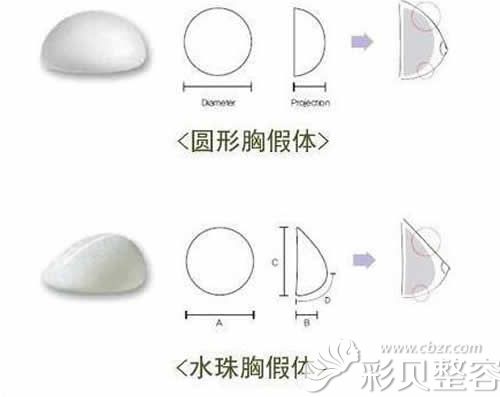 蓓拉假体型号介绍