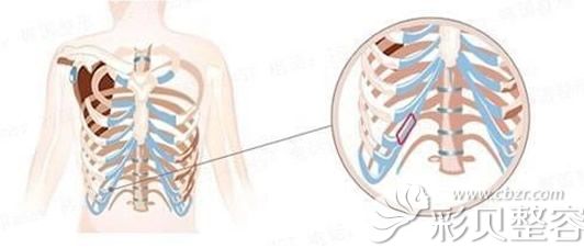 肋软骨切口位置示意图