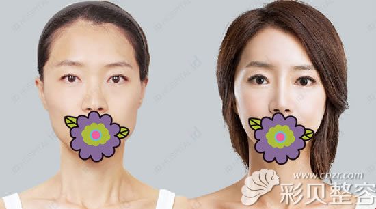 展示韩国id黄仁锡医生假体隆鼻前后对比图