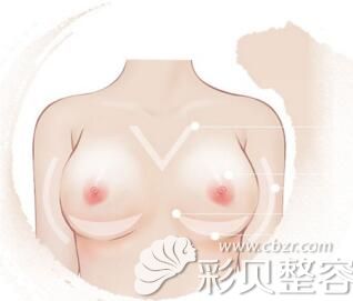 想知道女人不同年龄阶段的胸部形态 韩国艾恩整形来解析