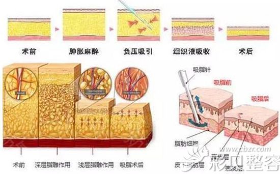 做吸脂前后对比效果图