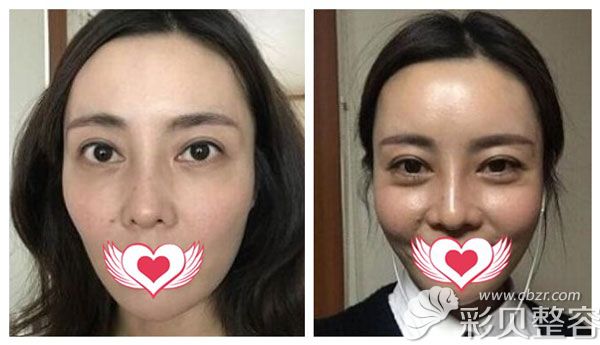 在韩国碧夏整形做硅胶+肋软骨隆鼻前后对比图