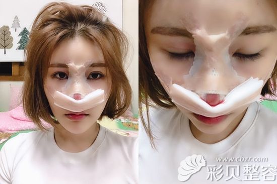 韩国艾恩护士做鼻综合手术当天