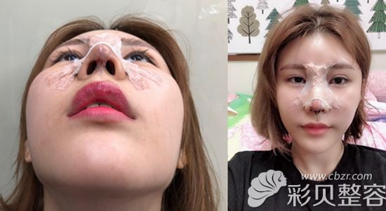 韩国艾恩护士做鼻综合手术后1天