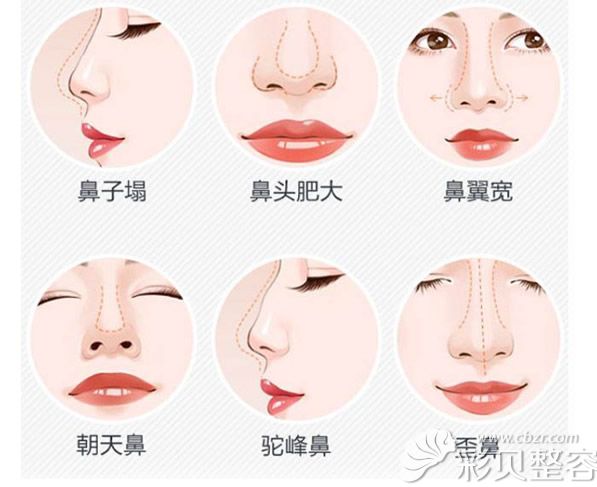 假体隆鼻能改善哪些问题